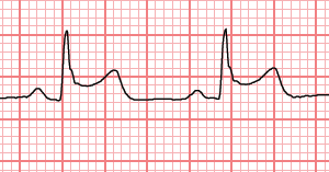 Practice Ecg Interpretation